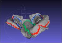 A computer model showing the mouth of a baby with a cleft lip.