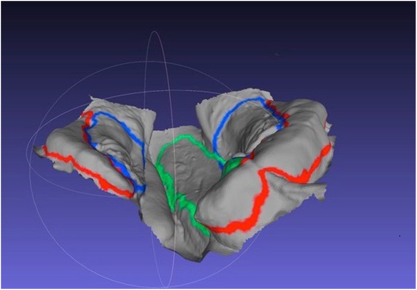 A computer model showing the mouth of a baby with a cleft lip.