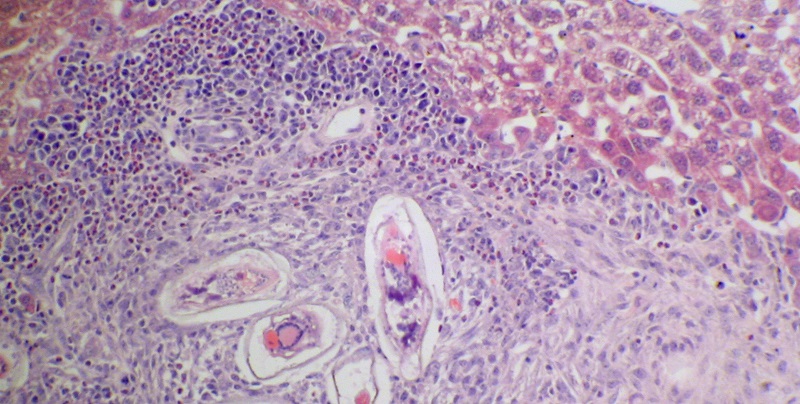 Schistosomiasis affects over 200 million people world-wide. Eggs (oval) produced by schistosome parasites accumulate in the host liver (pink cells) and induce an inflammatory response (purple cells). This leads to pathological complications associated with schistosomiasis and death